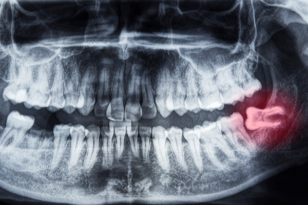 an xray image of teeth with wisdom tooth highlighted in red.